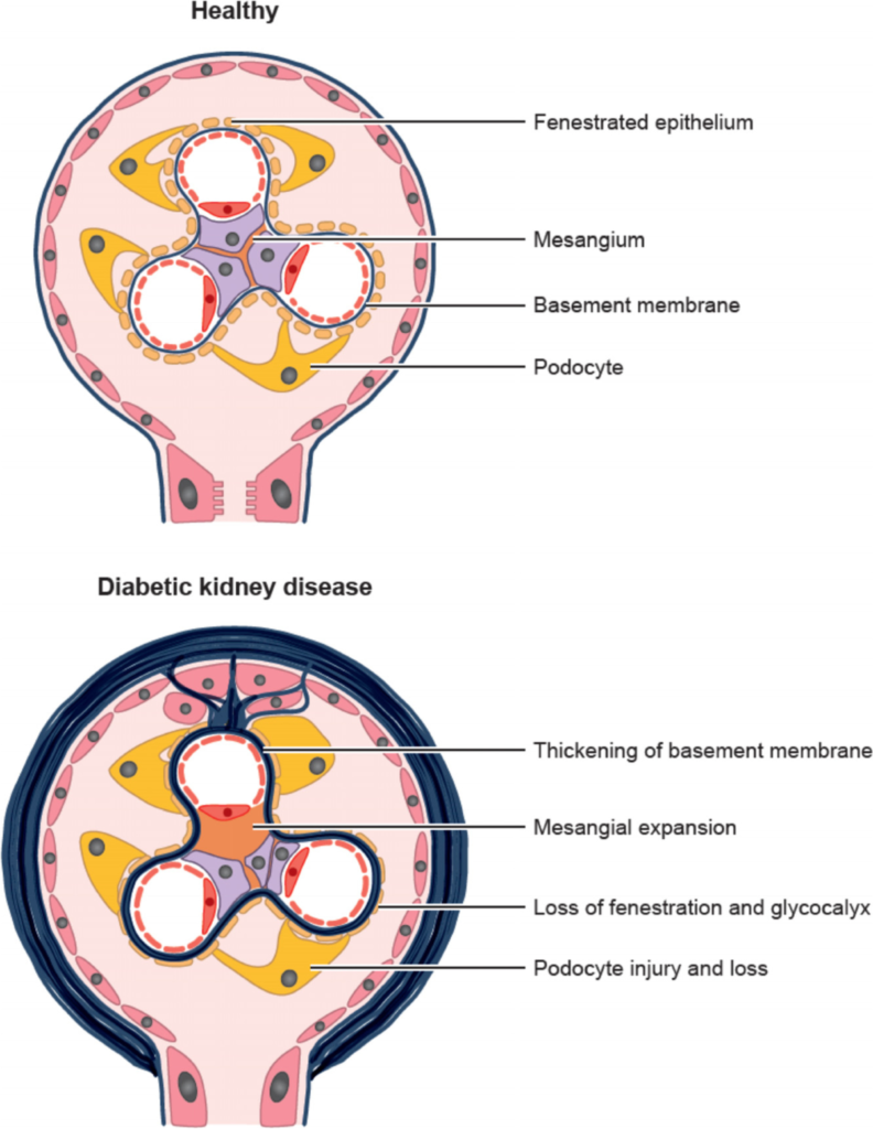 kidney disease treatment