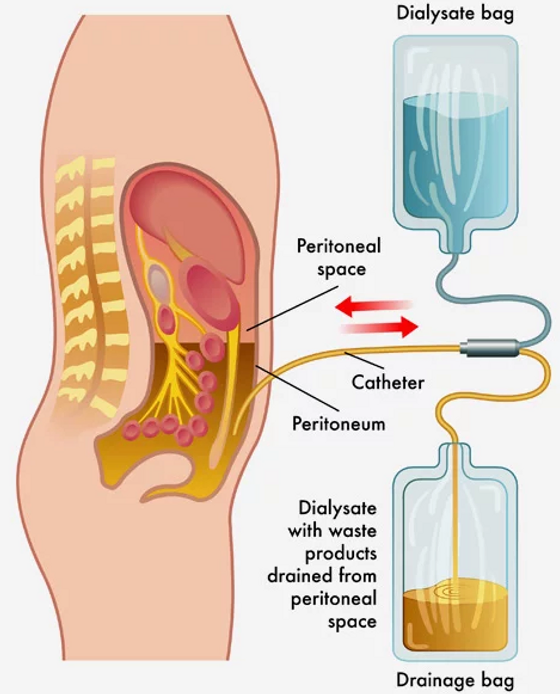 hemodialysis.kidney failure treatment