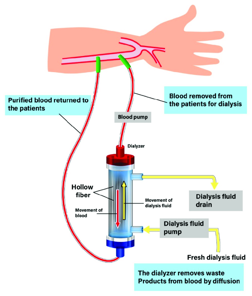 hemodialysis.kidney failure treatment