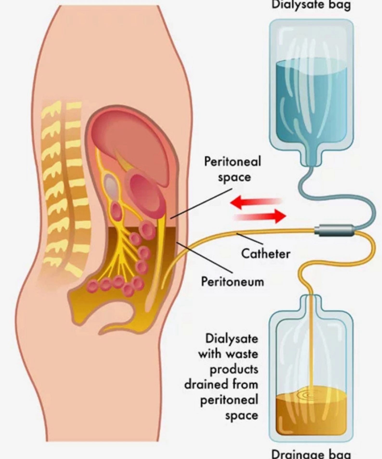 Peritoneal Dialysis